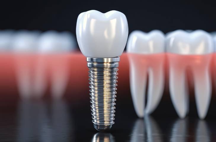 インプラントで金属アレルギーは起こる?原因とリスク、対処法を解説